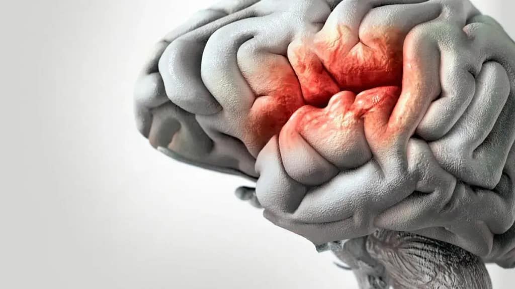 Accidente Cerebrovascular: Información Esencial y Estrategias de Prevención