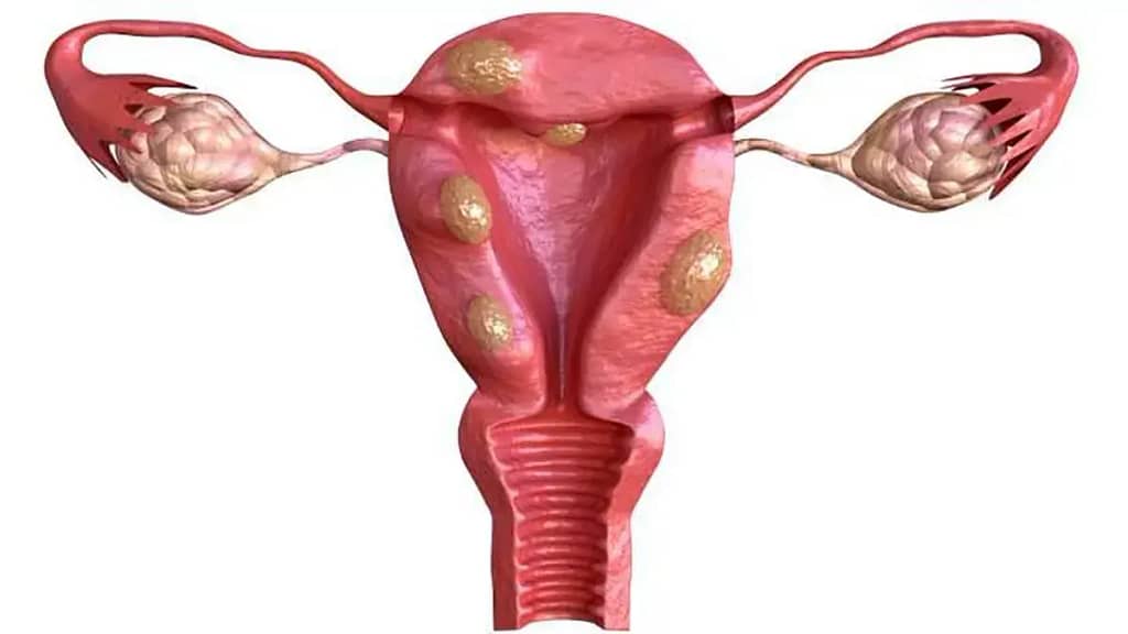 Explorando miomas uterinos: síntomas, diagnóstico y prevención