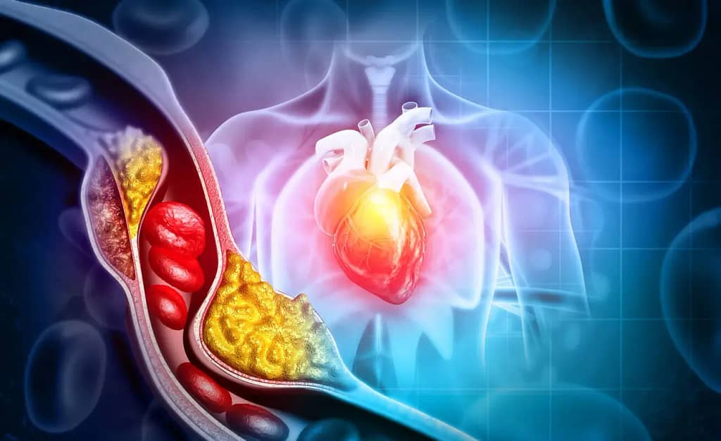 Descubriendo las causas del colesterol elevado y cómo combatirlo naturalmente