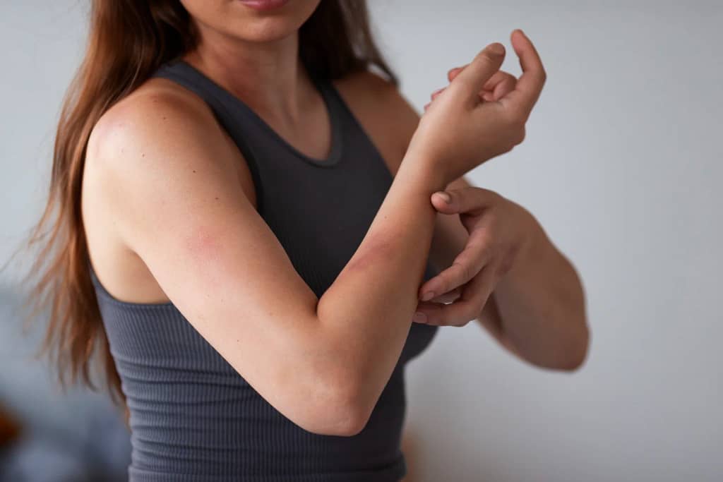 Dermatitis atópica: más que una afección cutánea
