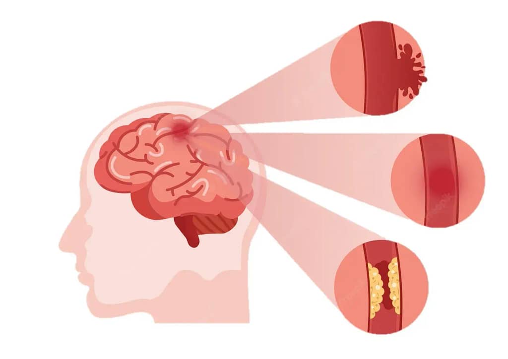 Todo lo que Necesitas Saber sobre el Accidente Cerebrovascular: Tipos, Síntomas y Tratamientos