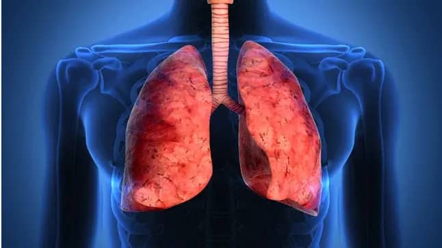 Fibrosis Pulmonar: Todo lo que Debes Saber